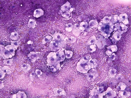 MGG stained smear of a C2 vertebral chordomal mass