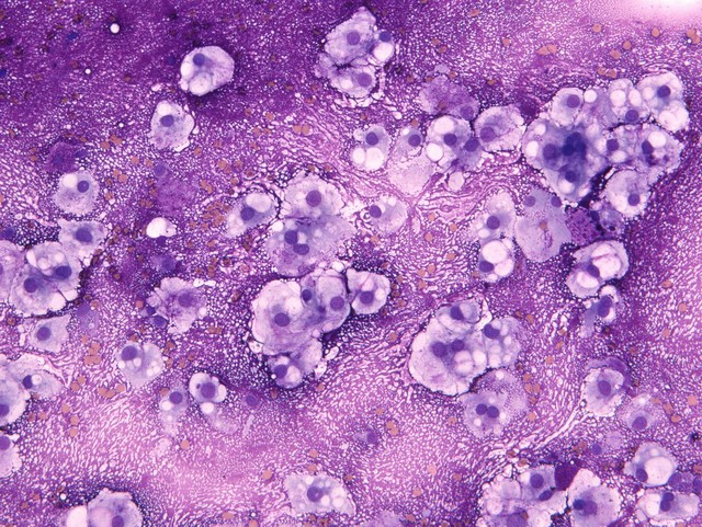MGG stained smear of a C2 vertebral chordomal mass