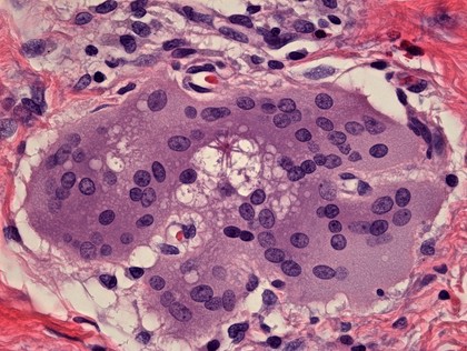 Multinucleated giant cell containing an asteroid, microscopy.