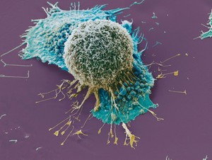 view Lung cancer cells grown in culture, SEM