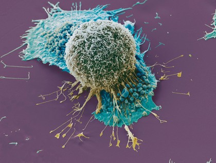 Lung cancer cells grown in culture, SEM