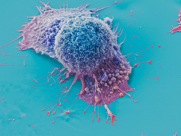 Lung cancer cells grown in culture, SEM