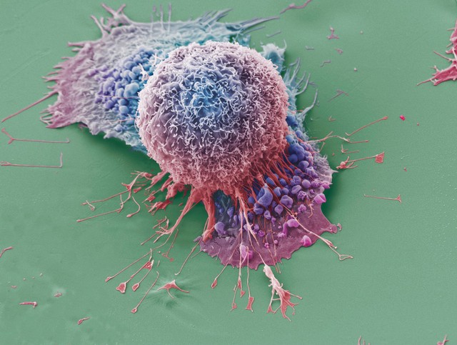 Lung cancer cells grown in culture, SEM