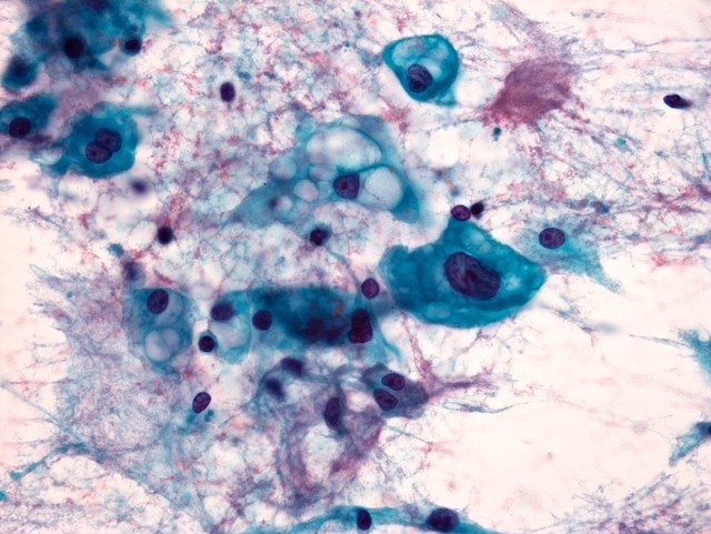 Papanicolaou stained smear of a C2 vertebral chordomal mass, microscopy. Chordomas are cancers formed of cells which resemble those of the notochord (spine) of a developing foetus. Although they can present anywhere within the spine and skull, the majority grow in the sacral region of the spine, corresponding to the lower back. This image shows a Papanicolaou (pap) stained smear obtained from a needle biopsy of a chordoma of the C2 vertebrae, located at the top of the neck just underneath the base of the skull.