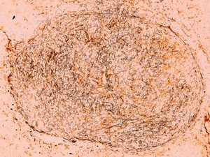 view Spirochete presentation in inguinal lymph node section