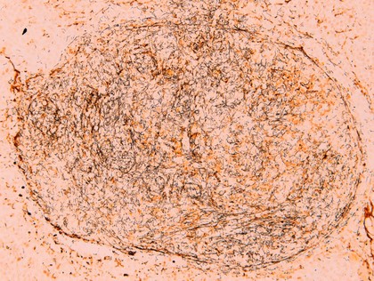 Spirochete presentation in inguinal lymph node section