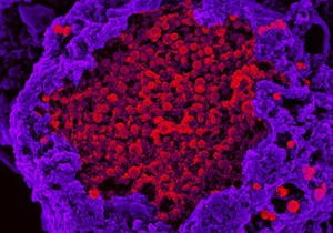 view Human macrophage rupturing after infection with Chlamydia