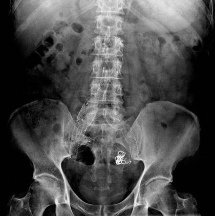 Endovascular Aneurysm Repair (EVAR), x-ray analysis