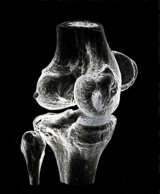 X-ray of a knee joint printed on coated aluminium, artwork