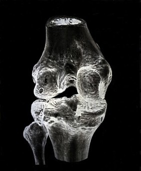 X-ray of a knee joint printed on coated aluminium, artwork