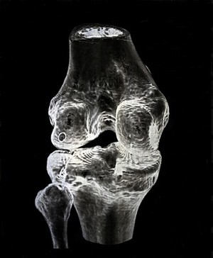 view X-ray of a knee joint printed on coated aluminium, artwork