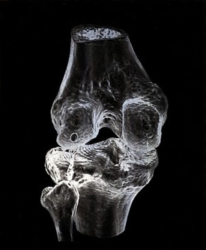 view X-ray of a knee joint printed on coated aluminium, artwork