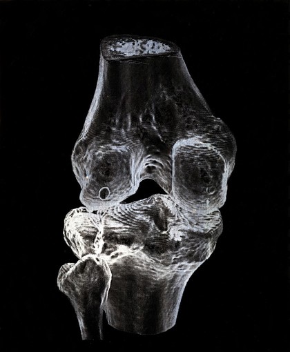 X-ray of a knee joint printed on coated aluminium, artwork