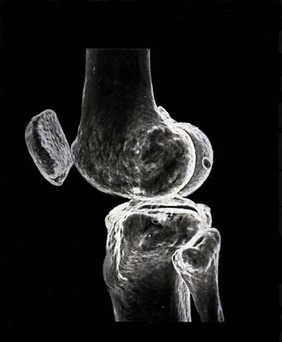 X-ray of a knee joint printed on coated aluminium, artwork