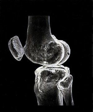 view X-ray of a knee joint printed on coated aluminium, artwork