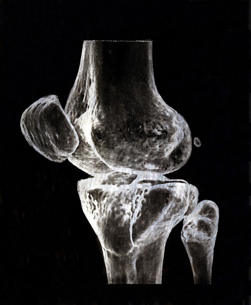 X-ray of a knee joint printed on coated aluminium, artwork