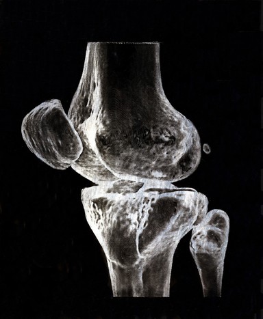 X-ray of a knee joint printed on coated aluminium, artwork