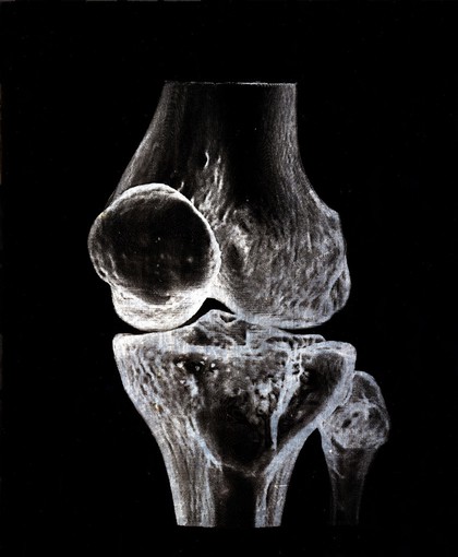 X-ray of a knee joint printed on coated aluminium, artwork