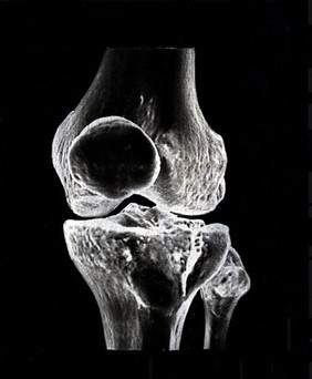 X-ray of a knee joint printed on coated aluminium, artwork