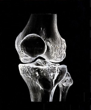 view X-ray of a knee joint printed on coated aluminium, artwork
