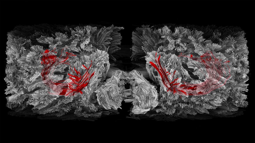 Arcuate Fasiculus, tractography