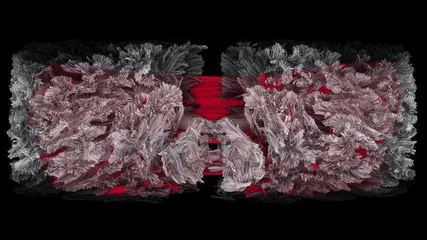Corpus Callosum, tractography