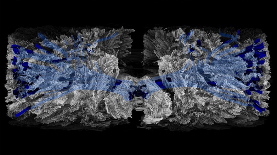 Corticospinal tract, tractography