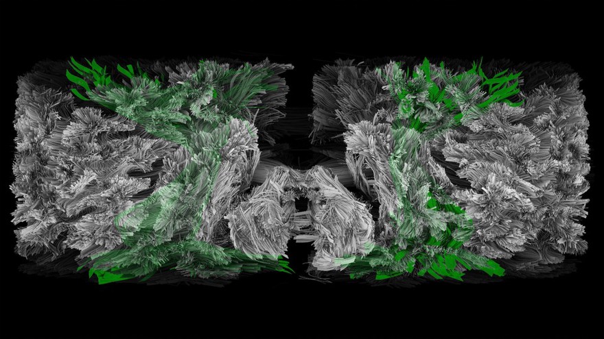 Brocke and Wernicke areas of brain, MRI
