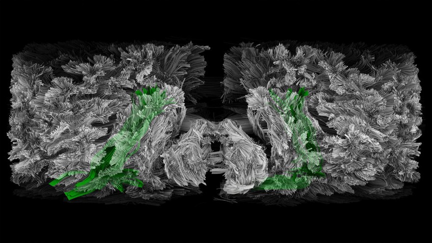Inferior Longitudinal Fasciculus, tractography
