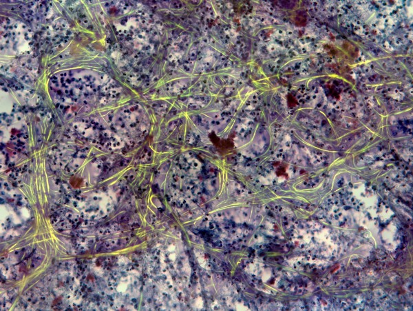 FNA Lung abscess