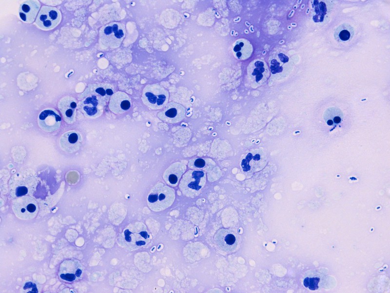 Image Result For Meningitis Image Result For Meningitis