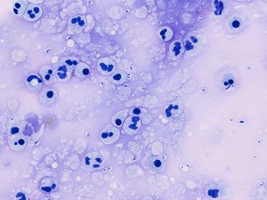 view Streptococcus pneumoniae meningitis CSF