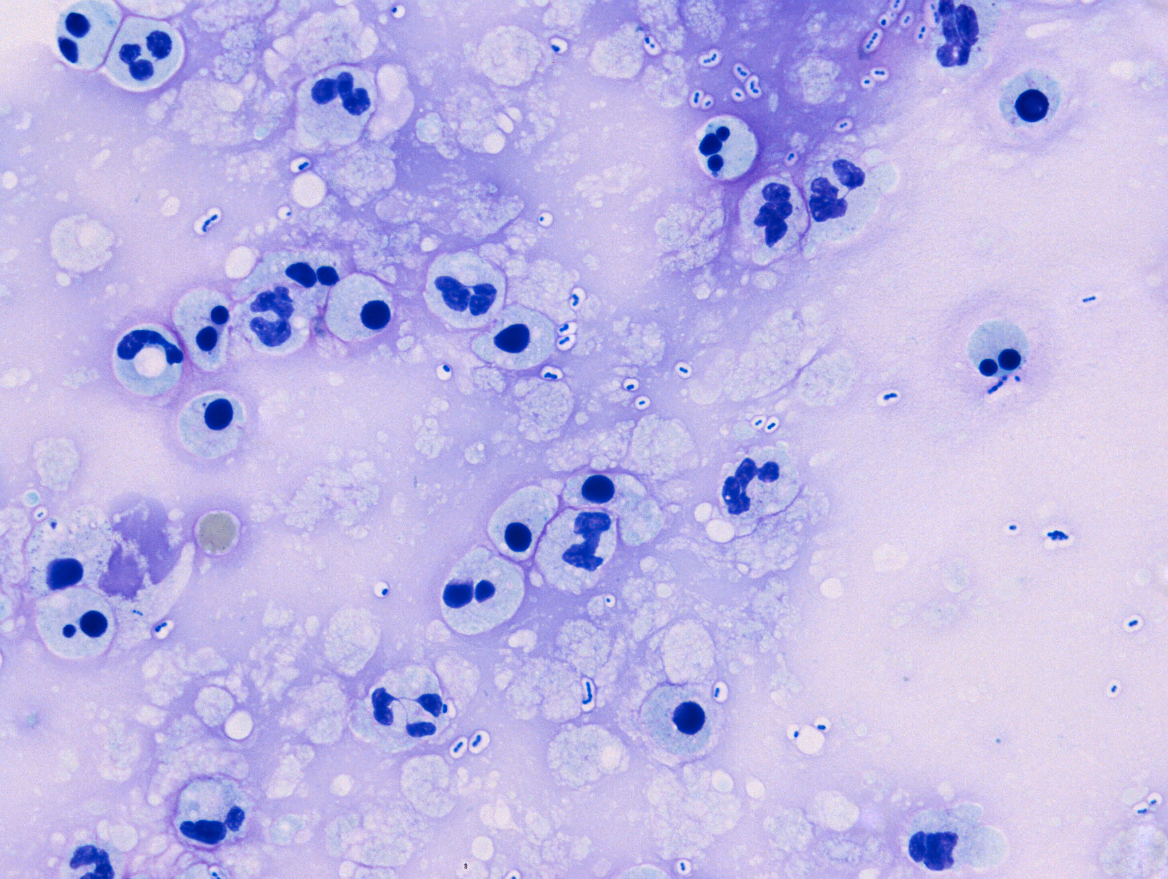 Streptococcus pneumoniae meningitis CSF Collection