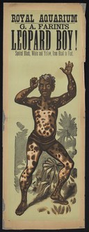 A black boy with white skin-markings (leukoderma), advertised for exhibition. Colour line block.