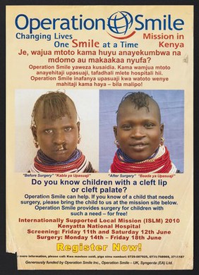 A girl with a cleft palate before and after surgery: Operation Smile in Kenya. Colour lithograph by Operation Smile, 2010.