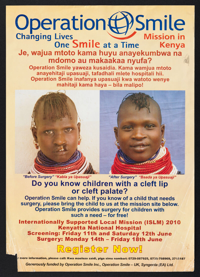 operation smile before and after