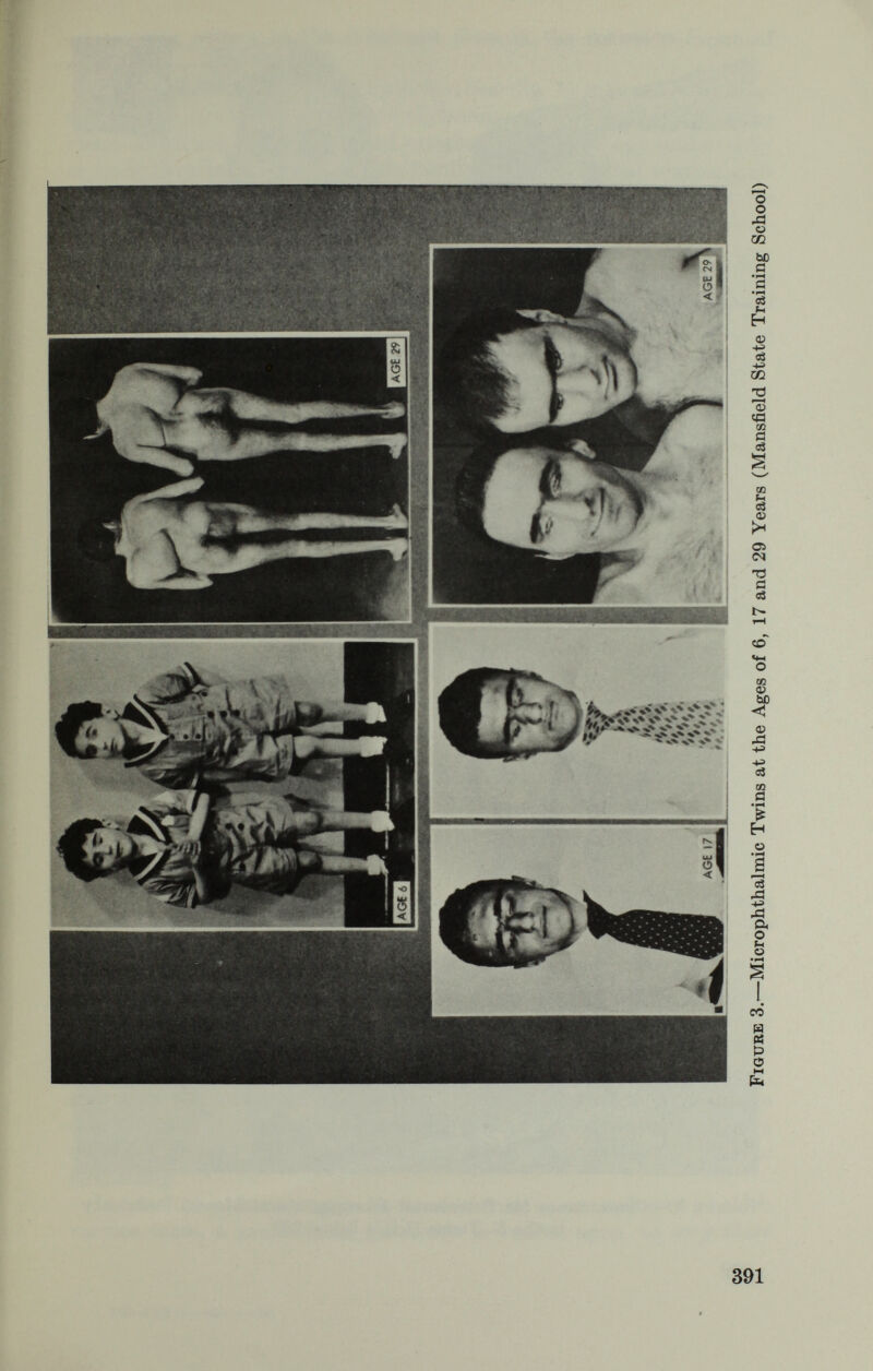 expressivity pattern in the dominant than in the recessive forms of deafness. The pedigree of one of our twin families (fig. 5) may serve to illus¬ trate variations in the expression of dominant genes, including hearing losses which are either of limited extent or expressed only unilaterally or later than in early life. This family contains a dual mating unit with five children, among them a pair of 1-egg twins concordant for partial ocular albinism and clinically discordant for early total deaf¬ ness. Of the 3 sibs of these twins, the oldest sister is deaf and hetero- chromic, like the mother and some members of her family. The two younger sibs have normal hearing, although the girl has partial ocular albinism, and the boy had one eye enucleated because of a histopathologically verified retinoblastoma (Sank, 1962). □ o HA PA PA R PA ■tO Ô I I NORMAL HEARING В EARLY TOTAL DEAFNESS (BILATERAL) Ц EARLY TOTAL DEAFNESS (UNILATERAL) 1Д PARTIAL HEARING LOSS (BILATERAL) В PARTIAL HEARING LOSS (UNILATERAL) H HETEROCHROMIA Д OCULAR ALBINISM PA PARTIAL OCULAR ALBINISM R RETINOBLASTOMA Figure 5.—Apparently Dominant Form of Early Total Deafness Showing Incomplete Expressivity and Association with Ocular Albinism, Heterochromia and Retinoblastoma in the R. Family 6. In another family which included a concordant pair of opposite- sex twins (fig. 6), 9 cases of deafness occurred in consanguineously related persons and were fully expressed, except for 1 case of partial hearing loss in a paternal aunt. Of the 3 dual matings in this family, one produced deaf offspring only, one hearing offspring only, and one a combination of deaf and hearing children—^thus providing us with a striking example of the technical complexities encountered in genetic counseling. In conclusion, it may again be stressed that, as a member of a health service team, a professional geneticist is called upon to empathize 393 735-712 O^—©5—^26