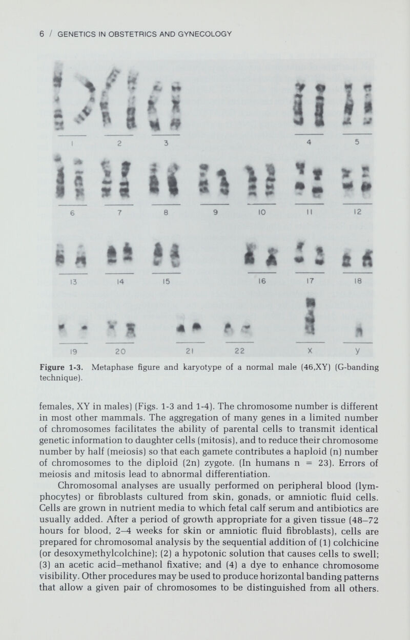 8 / GENETICS IN OBSTETRICS AND GYNECOLOGY Figure 1-6. Interphase cell showing Y-chromatin (arrow). (From Simpson JL: Disorders of Sexual Differentiation, Etiology and Clinical Delineation. New York; Academic Press, 1976, p 31. Reprinted with permission.) be normal. In addition, regions of autosomal fluorescence may be mistaken for Y-chromatin. Analysis of cells from the parents of the fetus or person being studied could minimize these potential sources of error, but complete cyto¬ genetic studies are still preferable. CHROMOSOME IDENTIFICATION Chromosomes are numbered according to their size and centromeric po¬ sition (Fig. 1-3.). The centromere divides a chromosome into a short arm (ab¬ breviated p) and a long arm (q). Based upon the position of the centromere, one can classify a chromosome as metacentric (p and q equal in length), sub¬ metacentric (q slightly greater than p), acrocentric (q much greater than p, the centromere being nearly terminal), or telocentric (the centromere being ter¬ minal). Prior to 1969 Nos. 1, 2, 3, 16, and Y could be identified. Other chro¬ mosomes could only be placed in one of several groups: A (1-3), В (4-5), С (6-12 and X), D (13-15), E (16-18), F (19-20), and G (21-22). The X is a submetacentric chromosome intermediate in size betw^een Nos. 7 and 8. The Y is usually slightly larger than Nos. 21 and 22. With unhanded staining tech¬ niques, chromosomes belonging to one group can be distinguished from chro¬ mosomes of another group; however, within a given group chromosomes cannot always be distinguished from one another. Banding techniques (Table 1-1) can now produce horizontal stripes that permit each chromosome to be distinguished from any other. The initial ad¬ vances were made by Caspersson, Tomakka, and Zech (1971), who observed that chromosomes stained with quinacrine and analyzed by fluorescent mi¬ croscopy showed a distinctive staining pattern. Each chromosome consists of bands, which human geneticists define as a region distinguishable from adja¬ cent segments by appearing darker or lighter (Paris Conference, 1971). A darkly staining or brightly fluorescent band is a positive band, whereas a lightly stain¬ ing band is a negative band. Thus, a positive Q-band fluoresces after staining with quinacrine. Several other methods are available (Table 1-1). A positive G- band is produced by heating chromosomes in sodium chloride and sodium citrate and staining with Giemsa or by pretreating cells with proteolytic en-