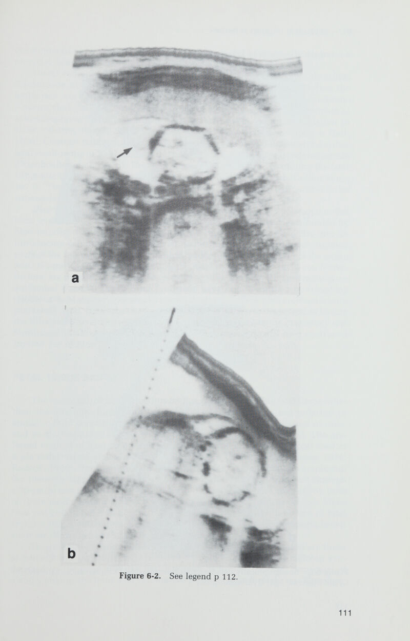 PRENATAL GENETIC DIAGNOSIS /113 development of two fetuses with achondroplasia and to prenatally diagnose a recessive form of metatropic dwarfism (Filly et al., 1974). Direct radiography has been used to diagnose Saldino-Noonan dwarfism (Richardson et al., 1977] and to demonstrate fetal radii to establish that the fetus was not affected with the thrombocytopenia-absent radii syndrome (Omenn et al., 1973]. However, at 20 weeks of gestation, x-rays of a number of achondroplastic fetuses and of a fetus with infantile osteopetrosis failed to show existing abnormalities (Golbus & Hall, 1974; Golbus, Koerper, & Hall, 1976]. Contrast radiography may use a water-soluble dye to demonstrate either fetal swallowing or its absence in the presence of esophageal or duodenal atresia (Duenhoelter et al., 1976]. This technique also can be used to outline the fetal silhouette to detect an abnormal mass or short-limbed dwarfism (Golbus et al., 1977]. The use of both direct and contrast radiography will probably be superseded by the development of better sonographic techniques. Direct fetal visualization utilizes a small-bore fiberoptic endoscope under local anaesthesia. The endoscope, which contains a solid lens surrounded by fiber bundles transmitting the light, is 1.7 mm in diameter and fits into an introducing cannula with an external diameter of 2.2 mm. Although isolated parts of the fetal anatomy are sporadically identified, visualization of the entire fetus is rarely accomplished, because the focal length is only 1 to 2 cm. Never¬ theless, six pregnancies at risk for either the Ellis-van Creveld syndrome or an autosomal dominant split-hand syndrome have been examined by fetoscopy (Hobbins & Mahoney, personal communication; Golbus and colleagues, un¬ published data]. On the basis of Polydactyly, one fetus was diagnosed as having the Ellis-van Creveld syndrome, and this was verified when the pregnancy was terminated (Mahoney & Hobbins, 1977]. There probably will be a continued limited use of direct visualization for prenatal diagnosis. FETAL TISSUE BIOPSY The major use of fetoscopy thus far has been for sampling fetal tissue other than the amniotic ñuid constituents. Many genetic defects not reflected in amniotic fluid constituents are demonstrable using other fetal tissues or cells, and most attempts to sample fetal tissues have involved fetal blood. The pre¬ ferred method of fetal blood sampling is by aspiration of an umbilical cord or a placental vessel visualized with the fetoscope (Hobbins & Mahoney, 1975; Rodeck, 1980]. For the rare case in which the fetoscope cannot be employed, the placenta may be sampled by sonographically directed aspiration through a 20-gauge needle (Kan et al., 1974b; Golbus, Kan, & Naglich-Craig, 1976]. Both of these methods may produce a mixture of fetal and maternal blood. Since fetal red cell volume is greater than that of adult cells, the presence of fetal erythrocytes is determined by analysis of cell volume by a Coulter particle cell analyzer (Kazazian et al., 1972]. The principle abnormalities that have come under investigation are those of hemoglobin structure and synthesis. Although the major hemoglobin syn¬ thesized by the fetus after the first few months in utero is HbF, composed of a and 7 chains, the fetus also synthesizes ß chains from 9 weeks on. Therefore,