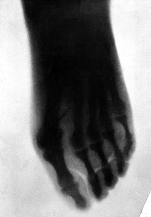 view Radiograph: foot of a pantomime artist.