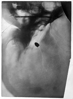 A bullet in the base of a skull, viewed through x-ray. Photoprint from radiograph after Sir Arthur Schuster, 1896.