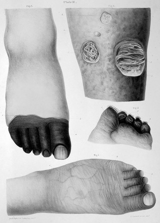 Pathological anatomy : illustrations of the elementary forms of disease / By Robert Carswell.