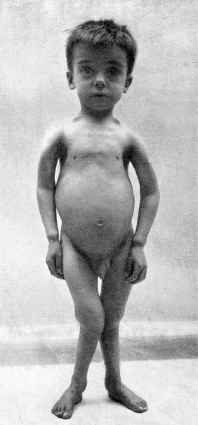Experimental rickets / by Edward Mellanby.