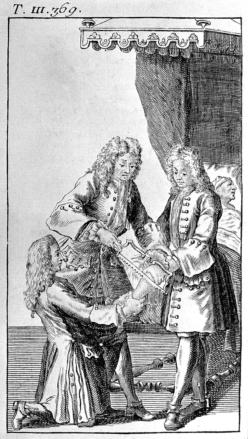 Amputation: 18th Century, Garengeot | Wellcome Collection