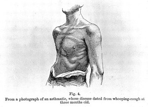 view H. H. Salter, On asthma: chest of an asthmatic