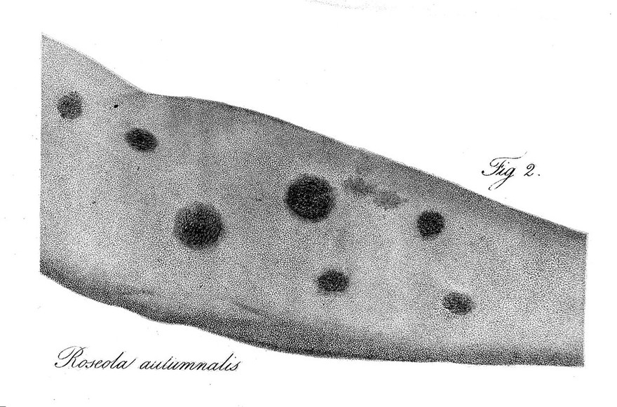 On cutaneous diseases ... / by Robert Willan.