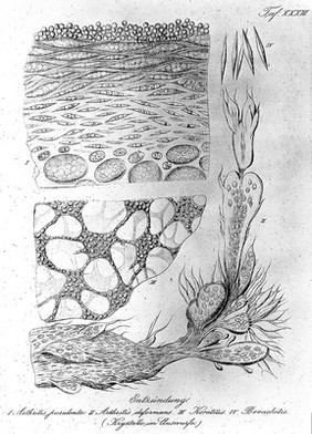 Atlas der mikroskopischen pathologischen Anatomie / gezeichnet und bearb. von August Foerster.