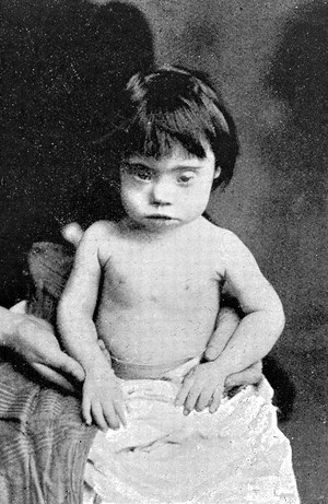 view Down syndrome child, 19th century.