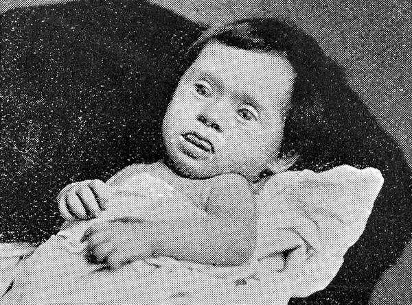 Down syndrome child, aged 3 months.