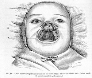 view Infant with cleft palate and cleft lip. 19th Century.